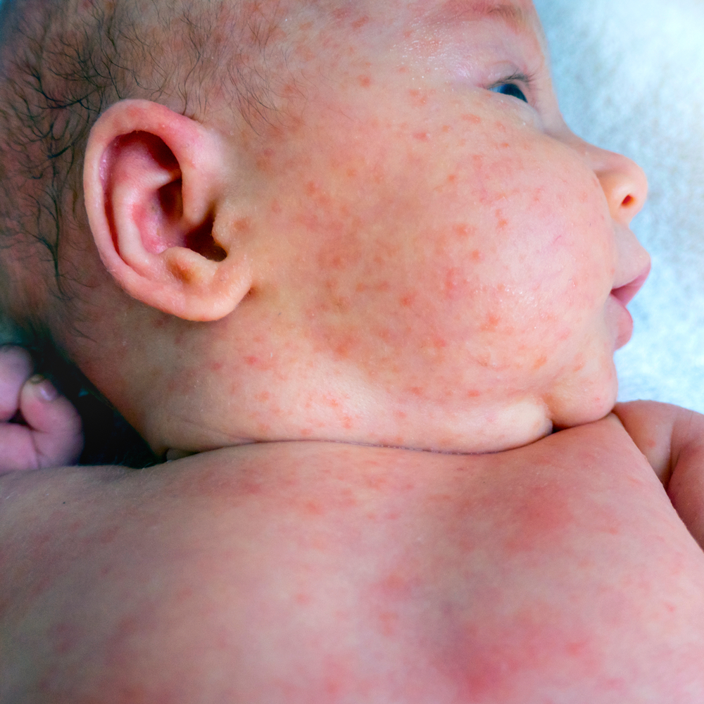 Dermatologia dziecięca lublin, leczenie skóry u noworodków