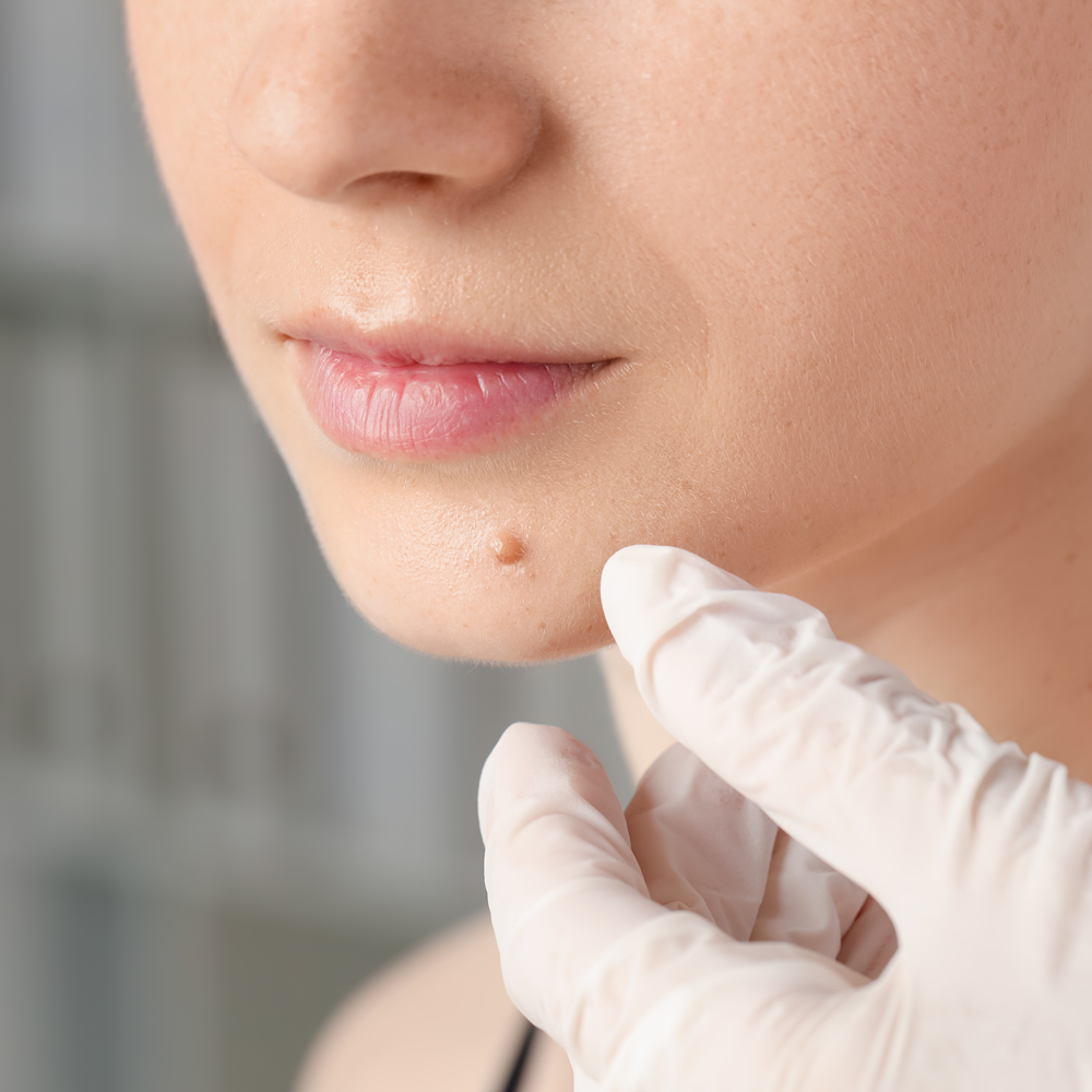 Leczenie za pomocą lasera frakcyjnego w lublinie