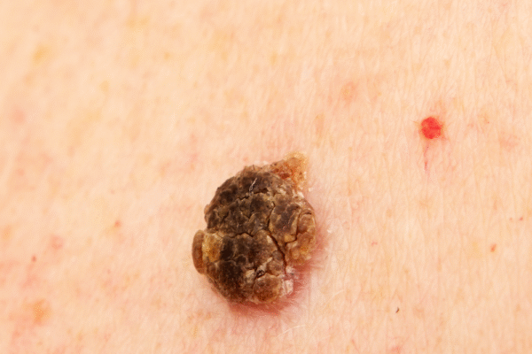 Niebezpieczny pieprzyk do usunięcia