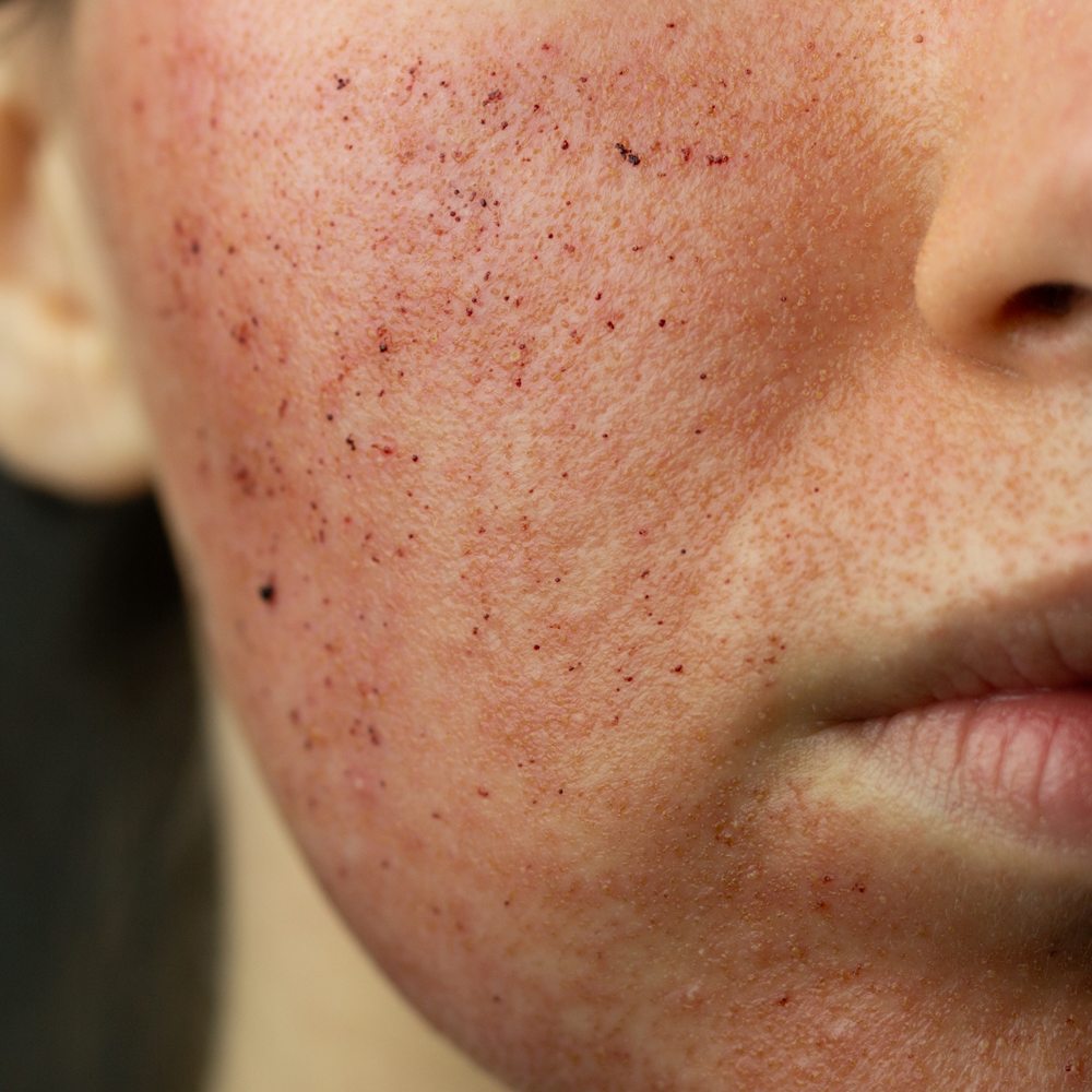 Skóra po zabiegu laserem frakcyjnym co2