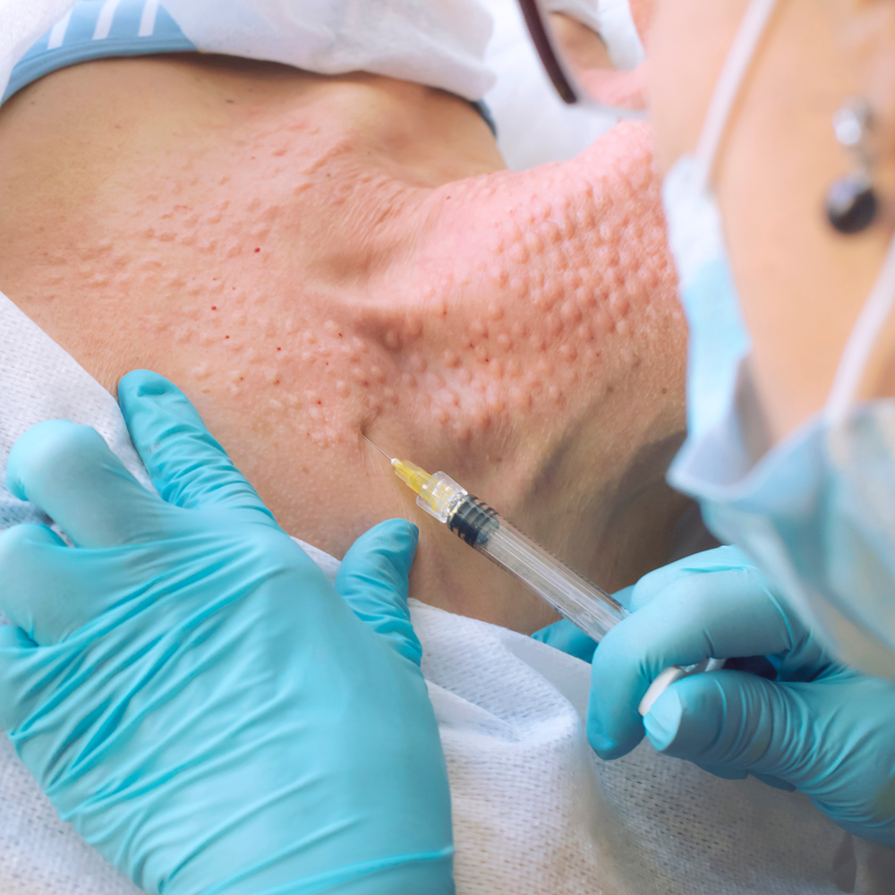 Mezoterapia igłowa w lublinie