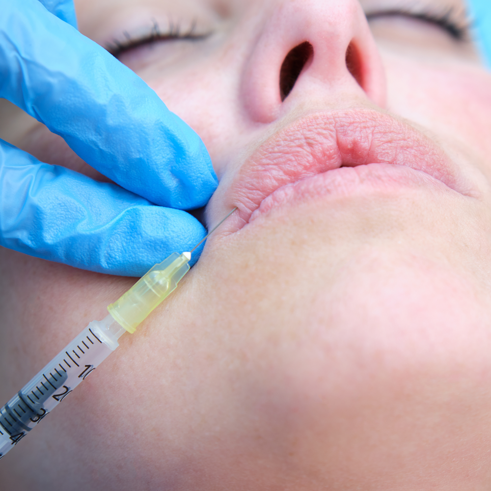 Uzupełnianie objętości ust w Lublinie, Medycyna Estetyczna