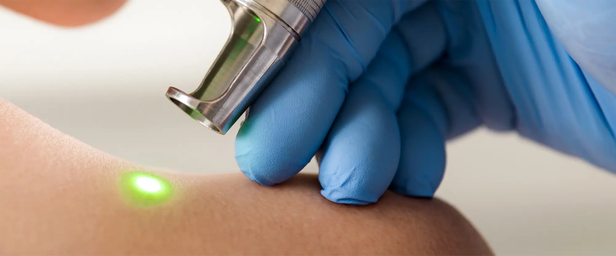 Laser CO2 lublin, laserowe usuwanie znamion w lublinie