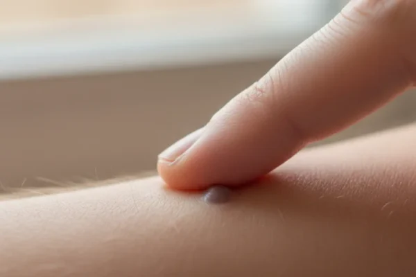 rozdrapany pieprzyk na jasnej skórze ramienia, uciśnięty palcem; jasne tło.