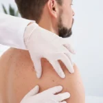 Brodawka łojotokowa badanie u dermatologa
